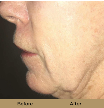 before-after-3-a