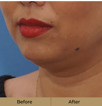 before-after-4-a