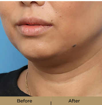 before-after-4-new-b