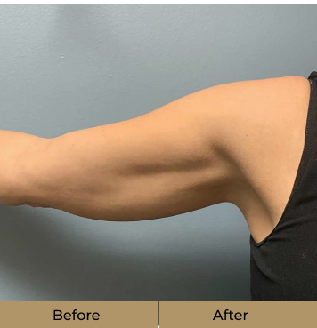 before-after-6-a