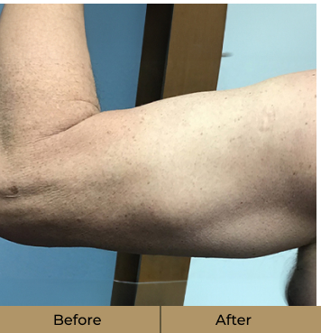 before-after-arms-b