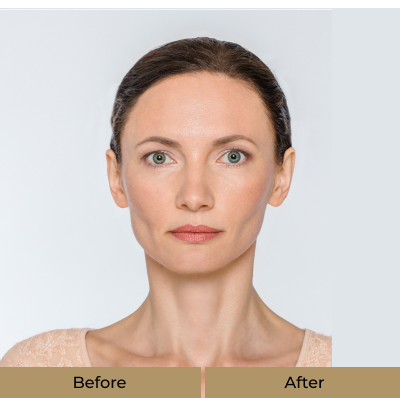 before-after-botox-b