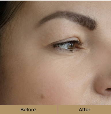 before-after-derma-fillers-b