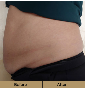 before-after-stomach-a