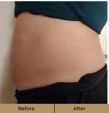 before-after-stomach-b
